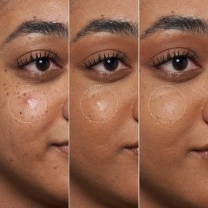 Alternative view of Blemish Defeat'r BHA Spot-Targeting Gel